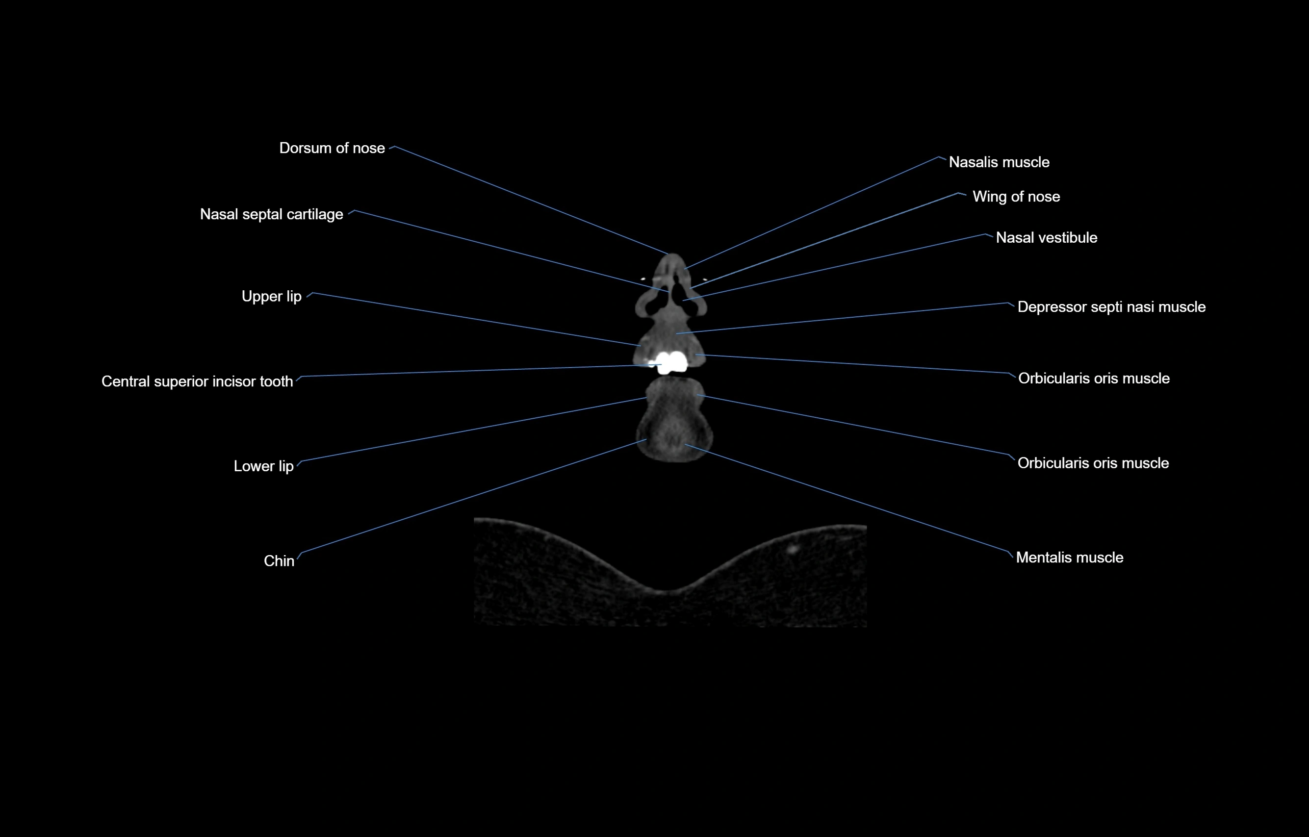 CT Neck coronal  cross sectional anatomy labelled 3D  radiology  image-00005.webp
